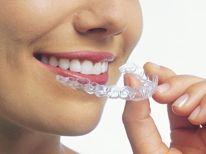 Innovative Invisalign Braces to Achieve an Improved Smile