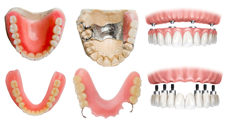 How Much Does It Cost For A Partial Denture?