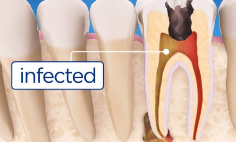 When do you need a root canal?