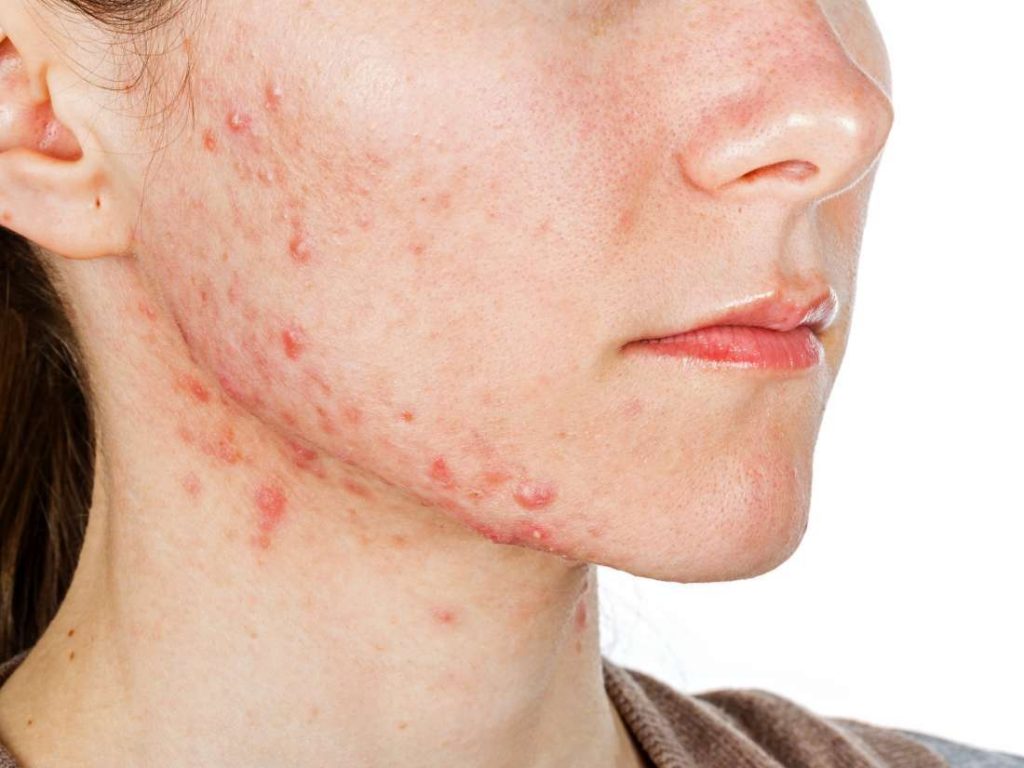acne treatment