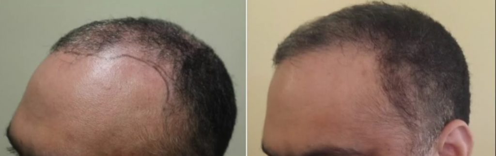 Debunking 8 Common Myths about PRP (platelet-rich plasma) Hair Loss Treatment