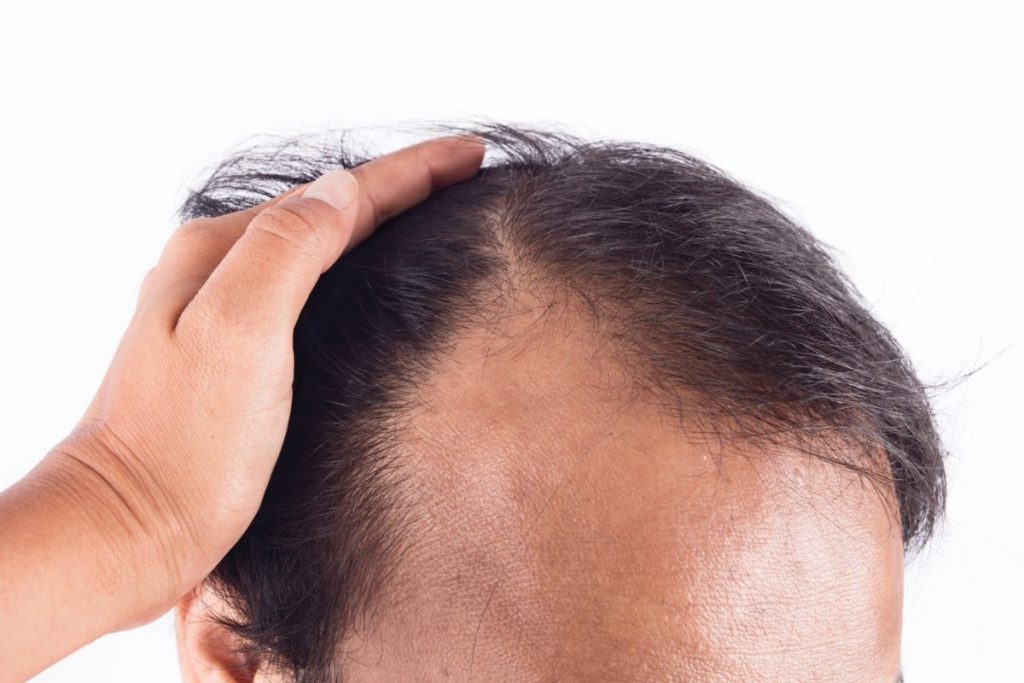 Hair Thinning After Hair Transplant