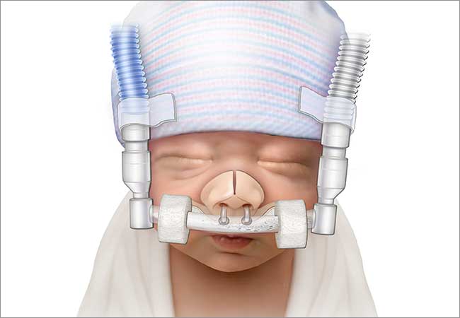 Bubble CPAP