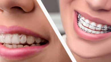 Photo of How to Pick the Right Color for Braces