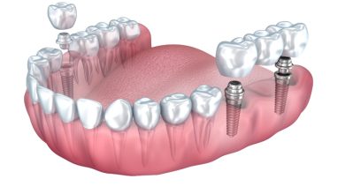 Photo of Dental Implant : Useful Tips To Increase Their Life