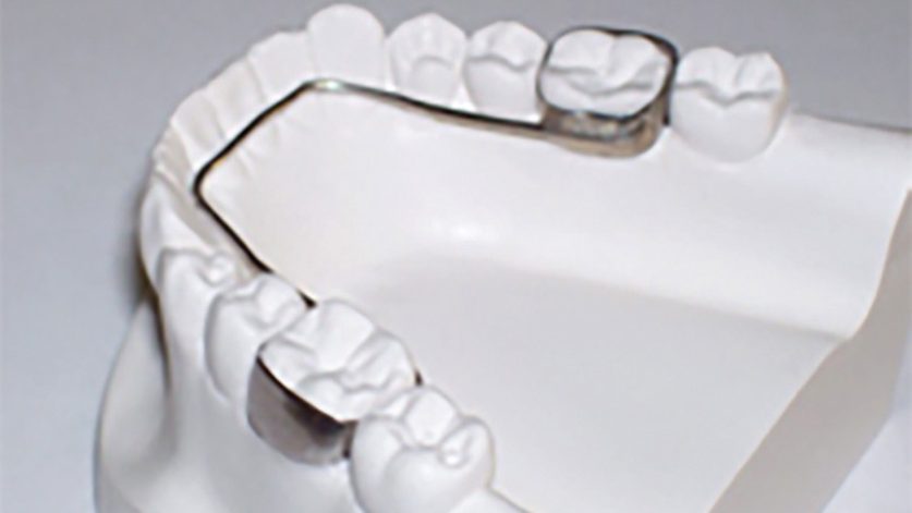 lower lingual holding arch
