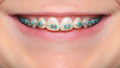 Photo of What Are Power Chains For Braces?