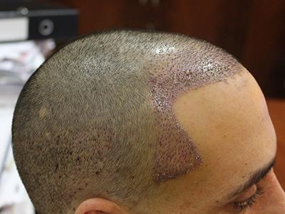 Hair Transplant