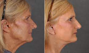 Photo of What Is Facelift Surgery (Rhytidectomy)?