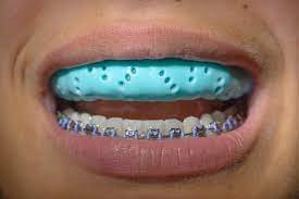 Photo of How To Protect Your Braces While Playing Sports?