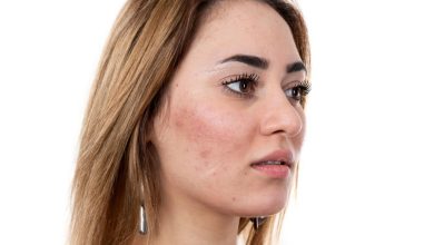 Photo of Treatments for Acne Scar Removal