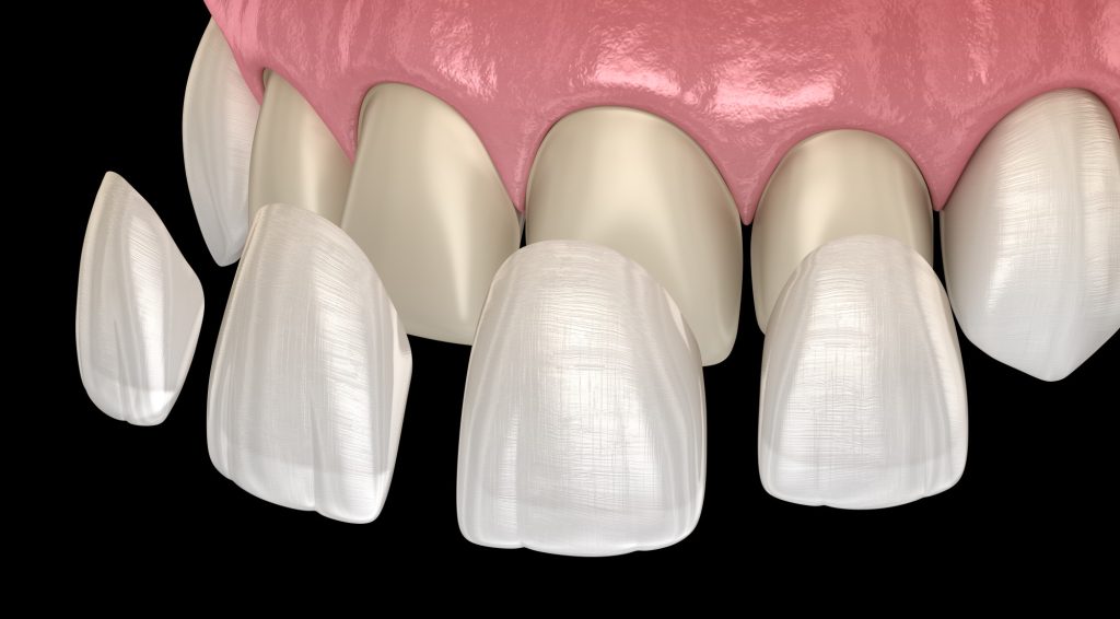 getting veneers