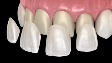 Photo of 5 Questions to Ask Before Getting Veneers