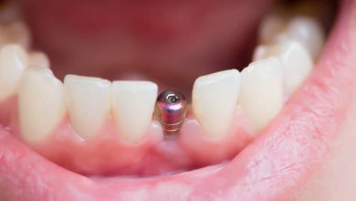 Photo of Advice For Speedy Recovery After Dental Implant Surgery