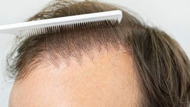 Photo of Tips for a Successful Hair Transplant Recovery